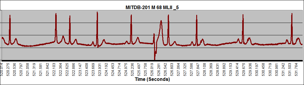 MITDB-201_MLII_Male_68Yrs-Old_472-531.997